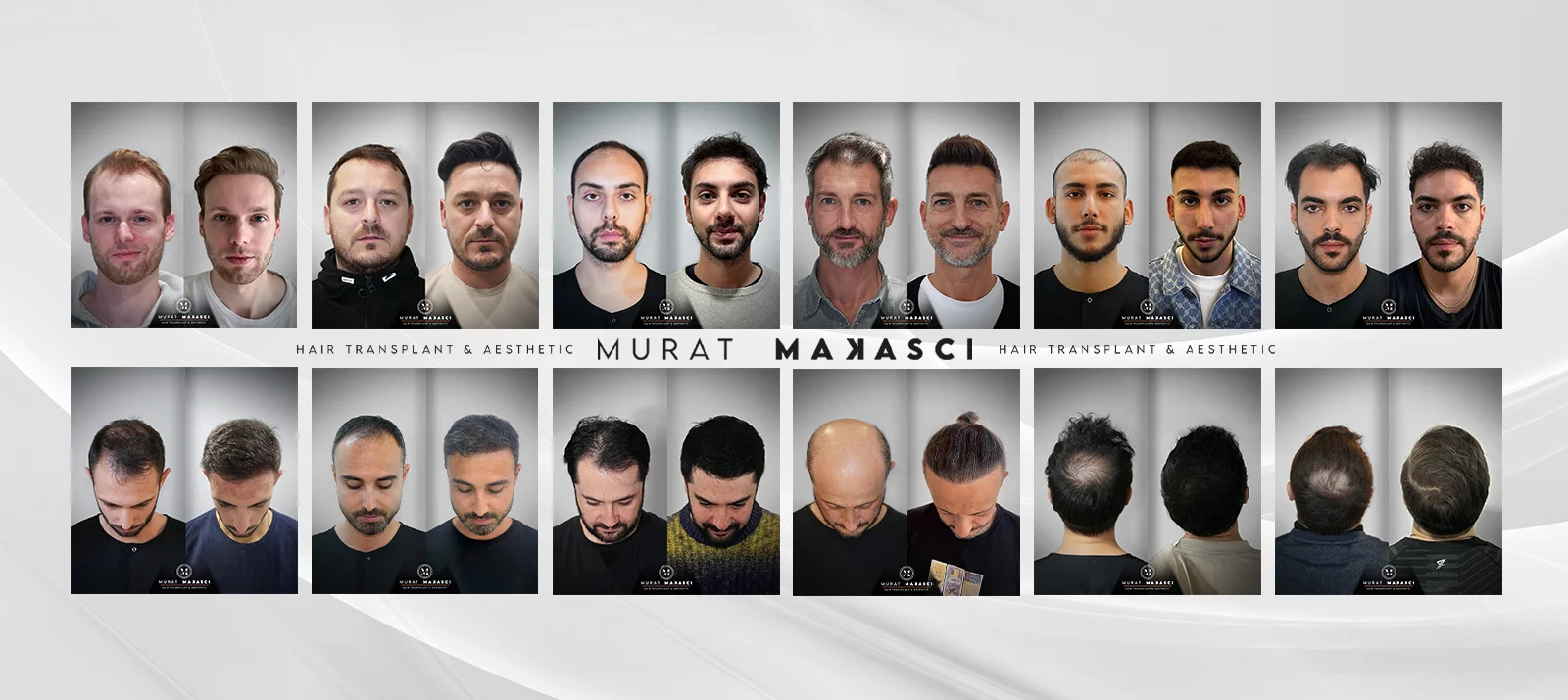 Résultats de la greffe de cheveux Murat Makasçı